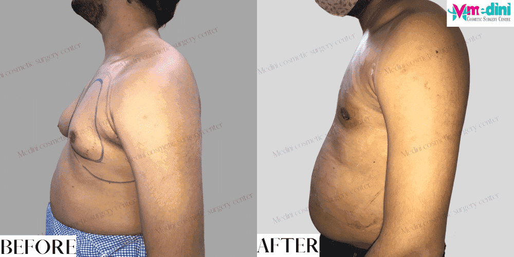 one side gynecomastia surgery before and after
