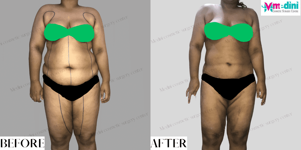 abdomen and thighs liposuction
