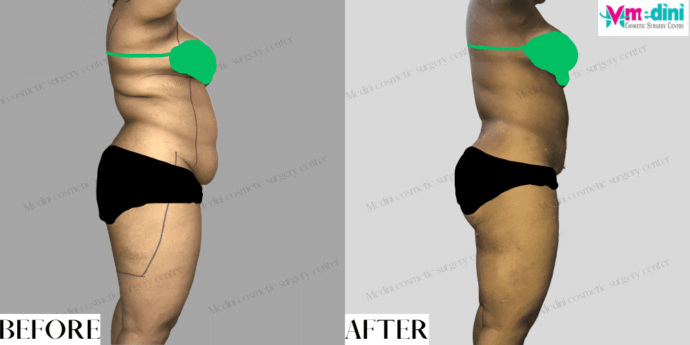 abdomen and thighs liposuction