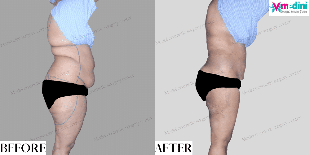 Liposuction before and after India Abdomen Thighs images