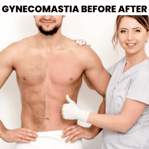 Gynecomastia Surgery - a Guy's Guide