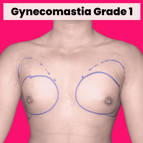 Gynecomastia Grade 1