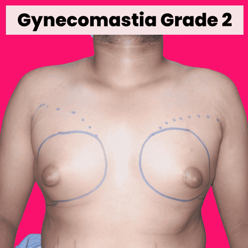 Gynecomastia Grade 2
