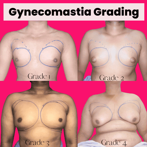 gynecomastia Grades