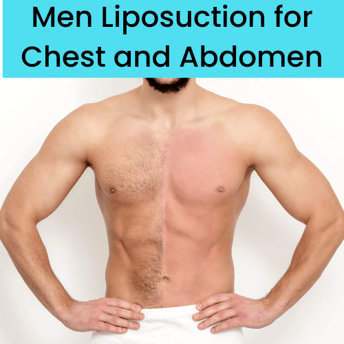men liposuction before and after at Medini Centre.
