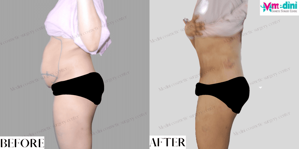 tummytuck surgery before and after