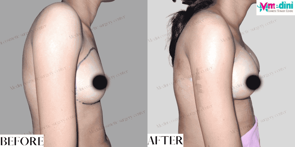 boob job after pregnancy - before and after