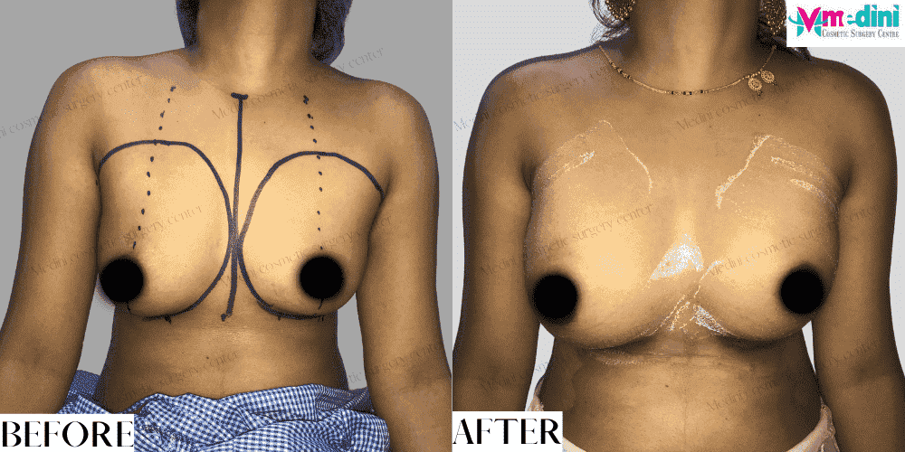 Boob job before and after with Breast implants
