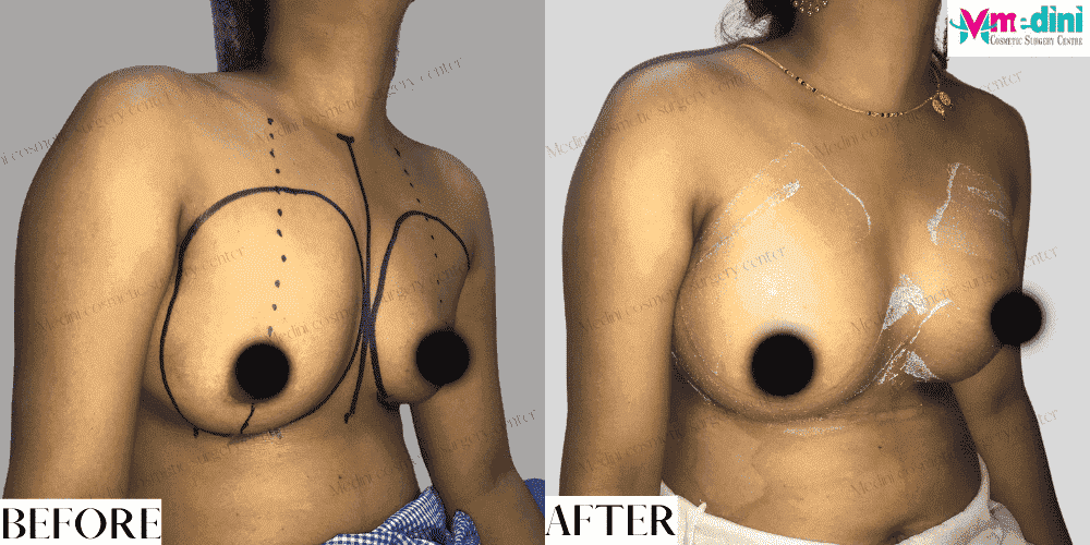 Boob job before and after with Breast implants