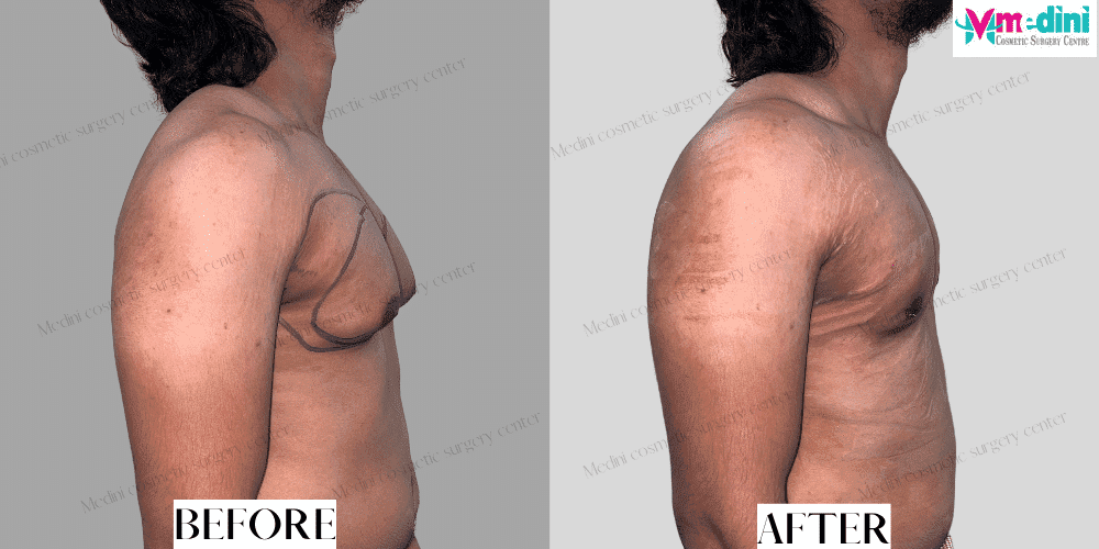 Gynecomastia Body builder before & after