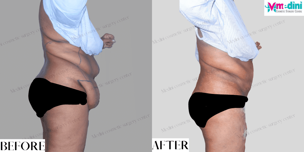 Abdominoplasty surgery before and after