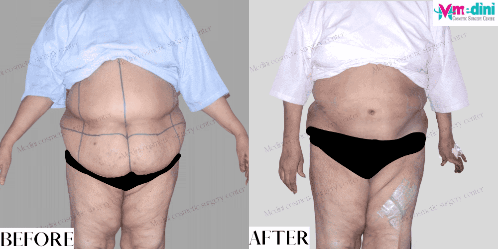 tummytuck surgery before and after